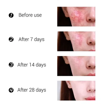 Tratament Acnee Crema De Fata Coș Gel De Reparare Ulei De Control Micsora Porii Cicatrice De Albire Crema De Îngrijire A Pielii Coreean Cosmetics15g